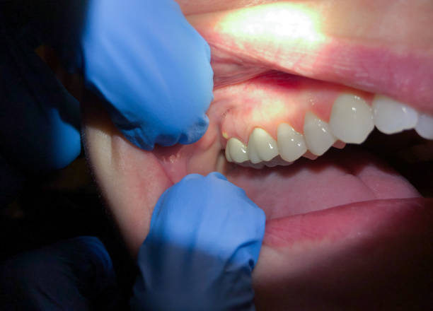Best Emergency Dentist for Lost Fillings or Crowns in Forks, WA